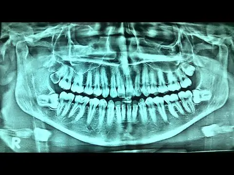 What is opg dental x-ray