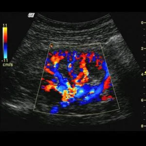 Color Doppler Test in Dehradun