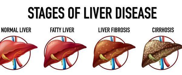 Elastrophy of the liver