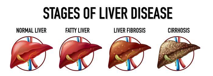 Elastrophy of the liver