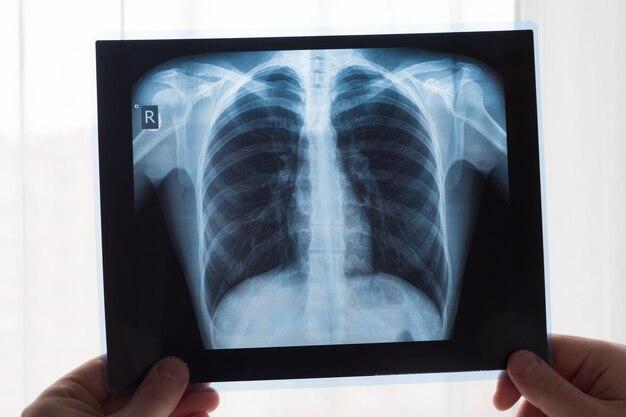 how many X-rays are safe in a month