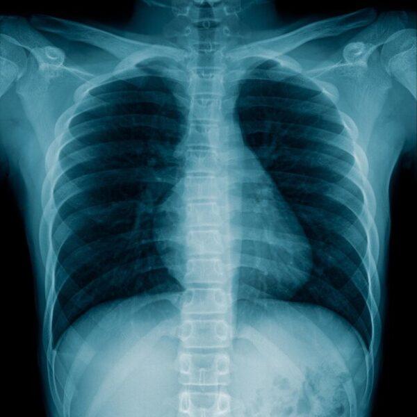 How Many X-rays Are Safe in a Month