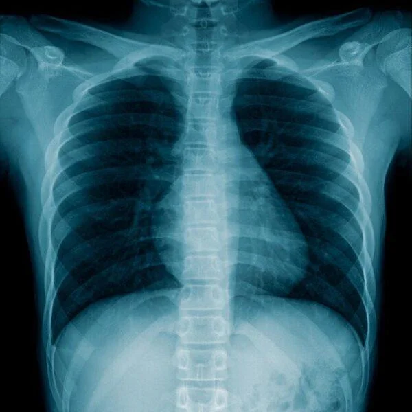 How Many X-rays Are Safe in a Month