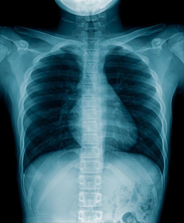 How Many X-rays Are Safe in a Month