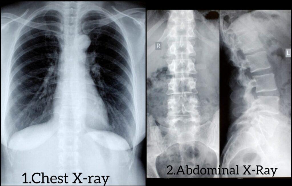 how many X-rays are safe in a month