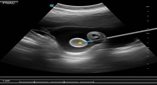 USG Guided FNAC Test